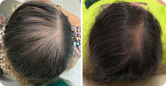 Antes e depois de tratamento capilar — segundo caso