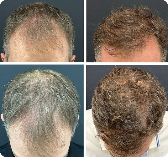 Antes e depois de tratamento capilar — quarto caso